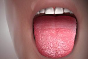 Dry Mouth natural cure